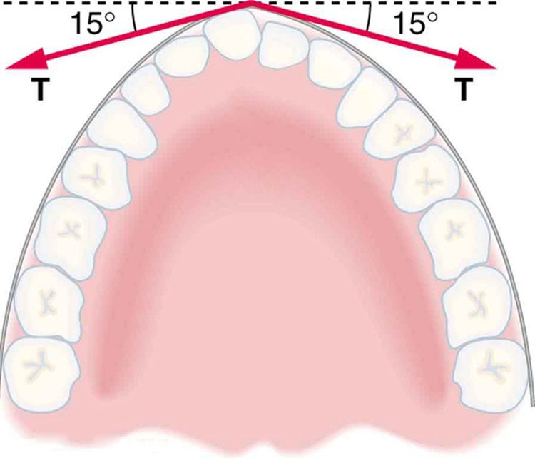 Cross-section of jaw with sixteen teeth is shown. Braces are along the outside of the teeth. Three forces are acting on the protruding tooth. A force, T, is shown by an arrow making an angle of fifteen degrees below the positive x axis, and a second force, T, is shown by an arrow making an angle of fifteen degrees below the negative x axis.