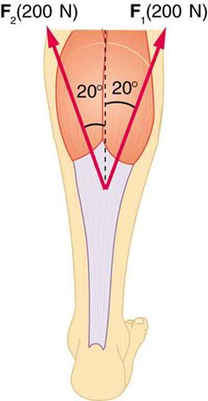 An Achilles tendon is shown in the figure with two forces acting upward, one at an angle of plus twenty degrees, one at minus twenty degrees. F sub one, equal to two hundred newtons, is shown by a vector making an angle twenty degrees toward the right with the vertical, and F sub two, equal to two hundred newtons, is shown making an angle of twenty degrees left from the vertical.