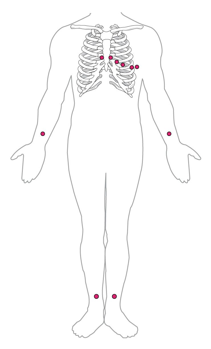 This diagram shows the points where electrodes are placed on the body for an ECG. Dots indicate the placement locations. There are six dots on on the chest and left side of the abdomen. There are dots on each wrist and just above each ankle.